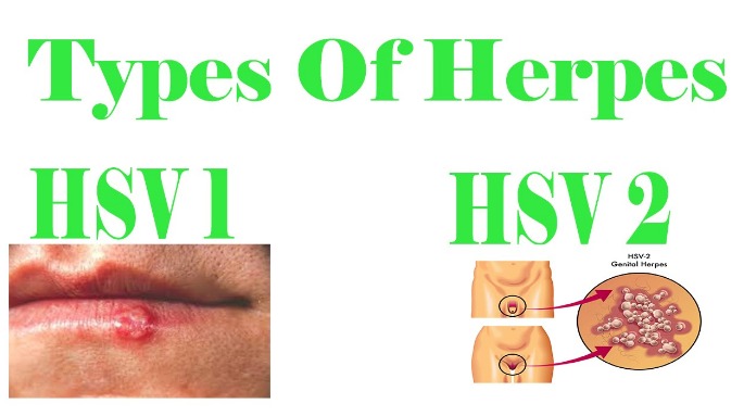 herpes-sinh-dục