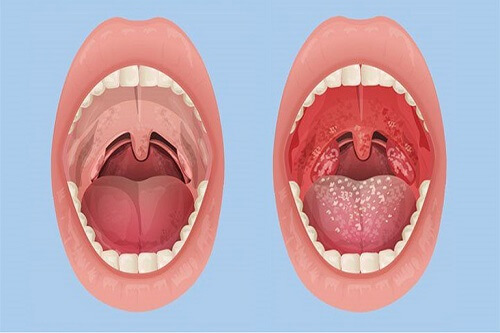 điều trị cuống lưỡi nổi nhiều hạt